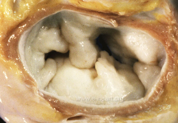 Mitral Valve Prolapse